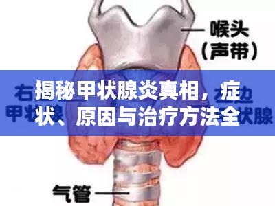 揭秘甲状腺炎真相，症状、原因与治疗方法全解析！